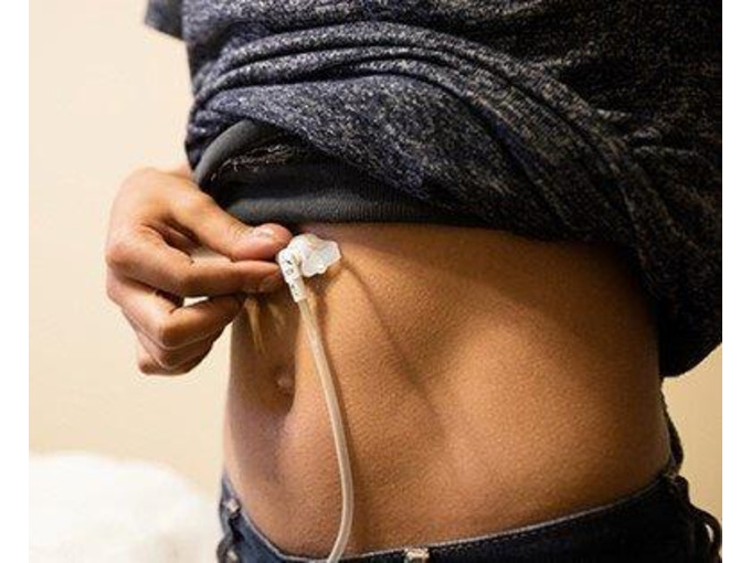 Courses > PEG Awareness Training 2 Care UK Ltd